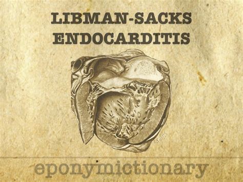 Libman Sacks Endocarditis
