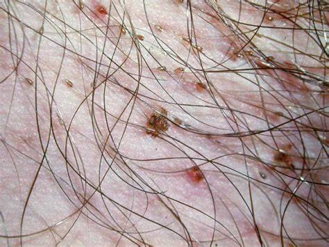 lice nude