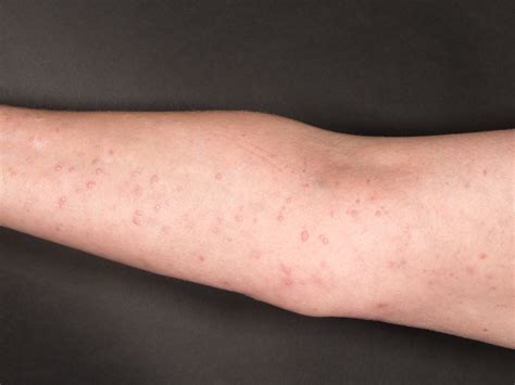 lichen ruber exanthematicus