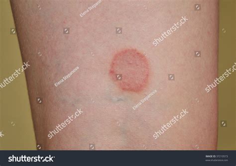 Lichen Ruber Planus