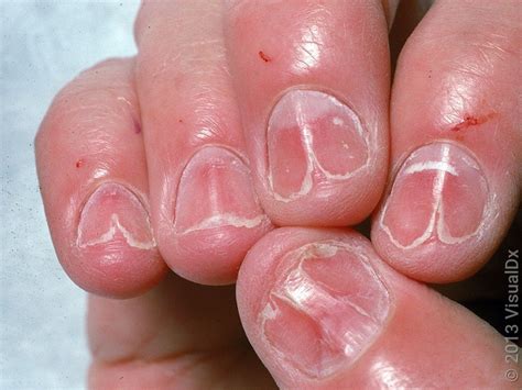 lichen ruber planus naglar