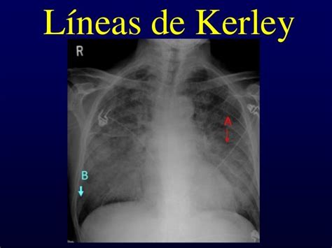 Lineas De Kerley