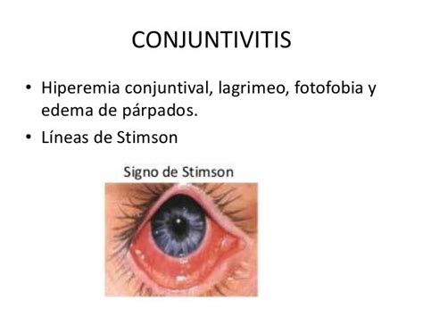 Lineas De Stimson