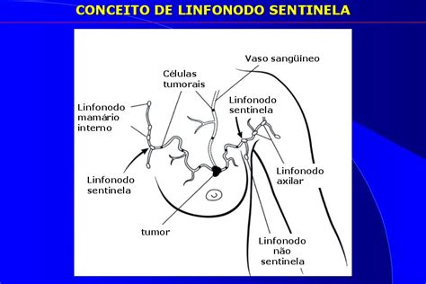 linfonodos na mama