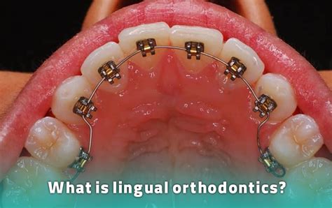 Lingual Orthodontics