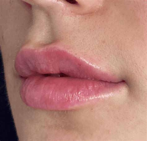 lip filler swelling not going down inside