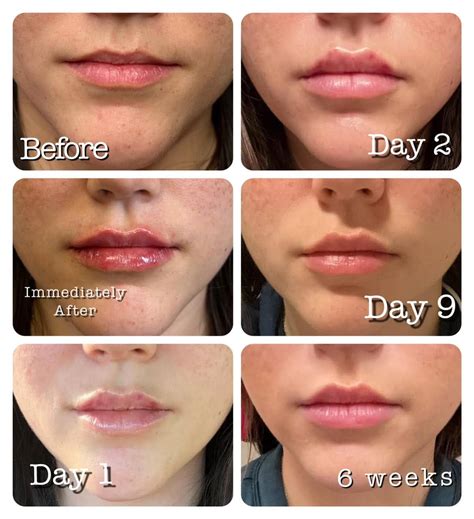 lip fillers swelling goes down inside front