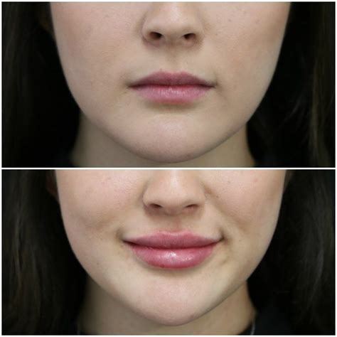 lip fillers swelling goes down leg joint