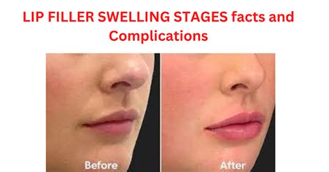 lip fillers swelling goes down leg muscles