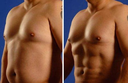 liposuctie sixpack