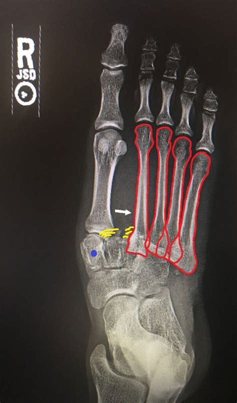 List Frank Fracture