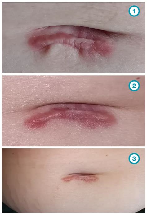 litteken behandeling