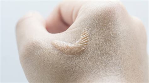 littekenweefsel jeuk