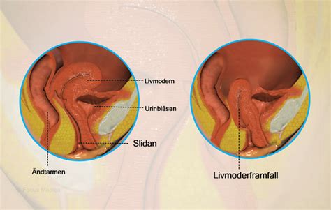 livmoderframfall häst