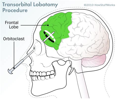 lobotomy adalah