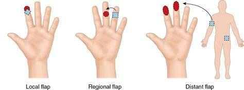 local and regional flaps in head and neck reconst