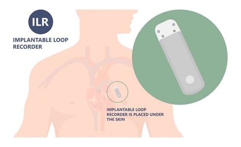 Loop Recorder Invalidità