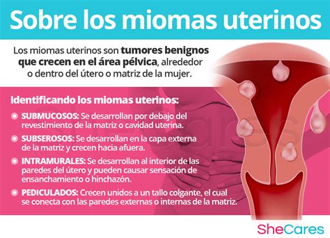 Los Miomas Producen Mal Olor