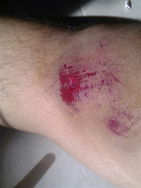 luka jatuh dari motor di lutut