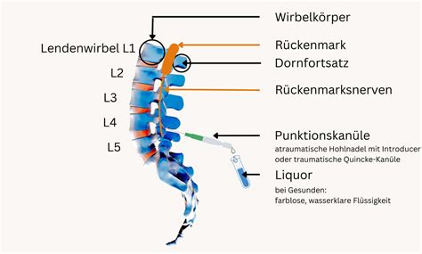 lumbalpunktion komplikationer