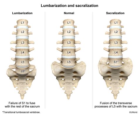Lumbarization Of S1