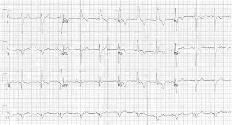 Lung Embolism Ecg