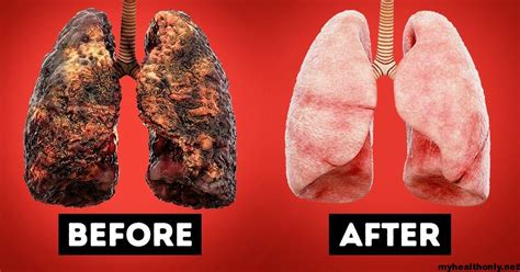 Lungs After Smoking Before And After