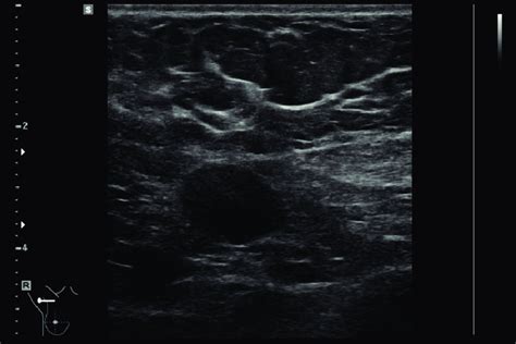 lymph node without fatty hilum - calidadinmobiliaria.com