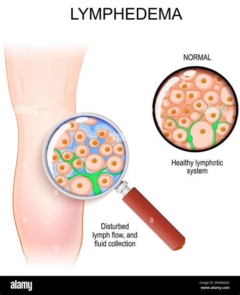 Full Download Lymphedema 