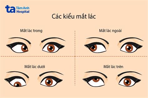 mắt lác | Bnh lc mt Triu chng nguyn nhn