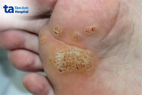 mụn cóc | 13 cch tr mn cc hiu qu