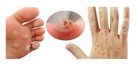 mụn cơm | Mn Cm Nguyn Nhn Du Hiu Nhn