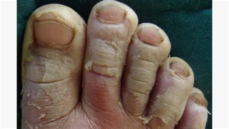 Macerated Wound