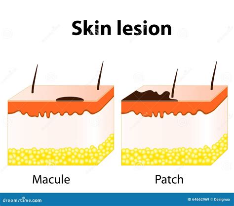 Macule Patch
