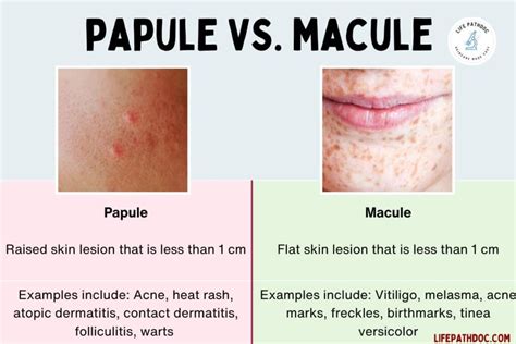 Macule Vs Papule