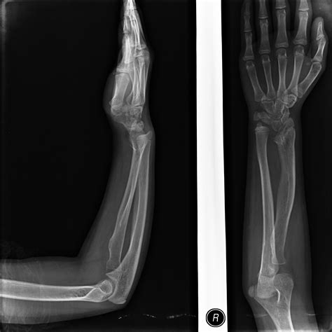 madelung deformity learning radiology elbow