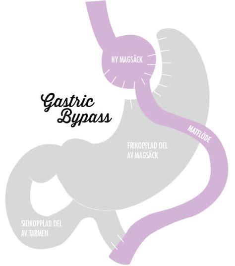 magsäcksoperation operation