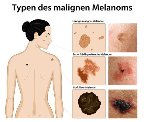 malignt melanom symtom bilder