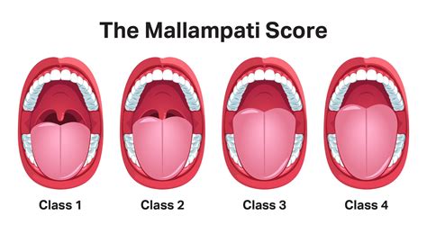 Mallampati Classification