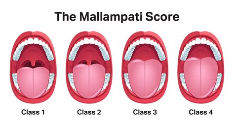 Mallampati Classification Score