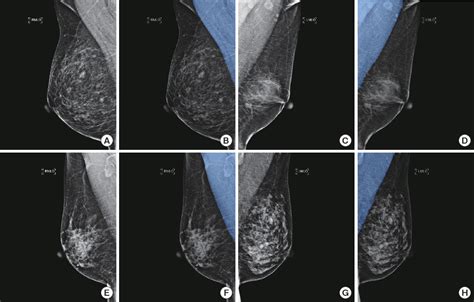 mammographic image analysis society mias database