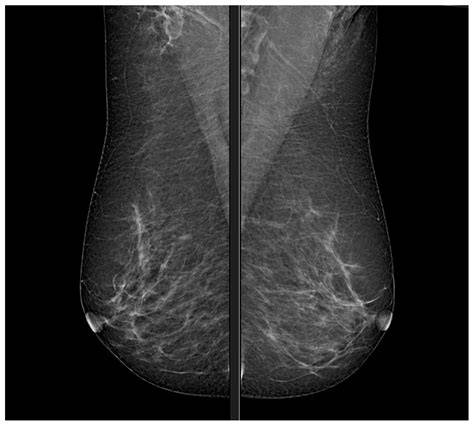 mammographic imaging