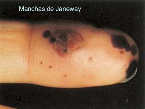 Manchas De Janeway