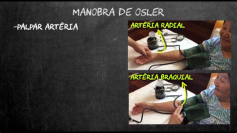 Manobra De Osler