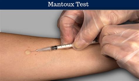 Mantoux Test Procedure