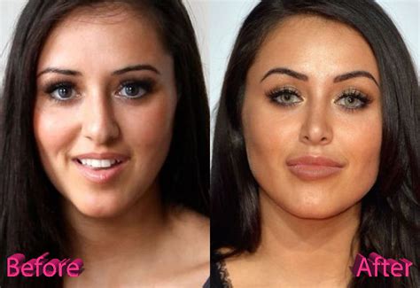 Marnie Simpson Before And After