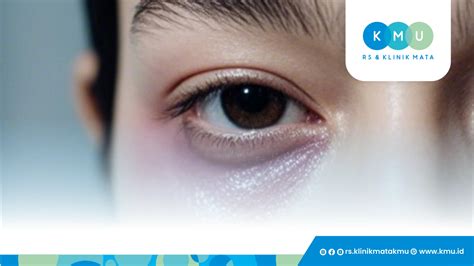 mata cekung | mata cekung Bunda gimana penglihatan bunda dengan