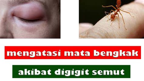 mata digigit semut | mata ankku digigit semut B Yu