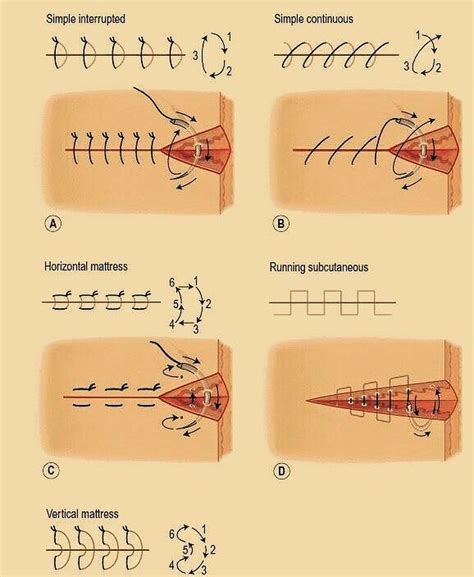 mattress suture 日本語の意味 - mattress suture とは - iChaCha