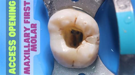 Maxillary First Molar Access Opening